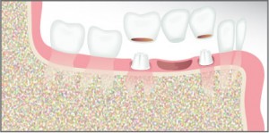 Dental Implant Bridge - Humble TX Dentistry