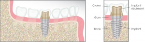 Dental Implant Illustration - Capstone Dentistry TX