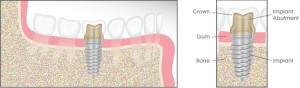 Dental Implant Illustration - Capstone Dentistry TX